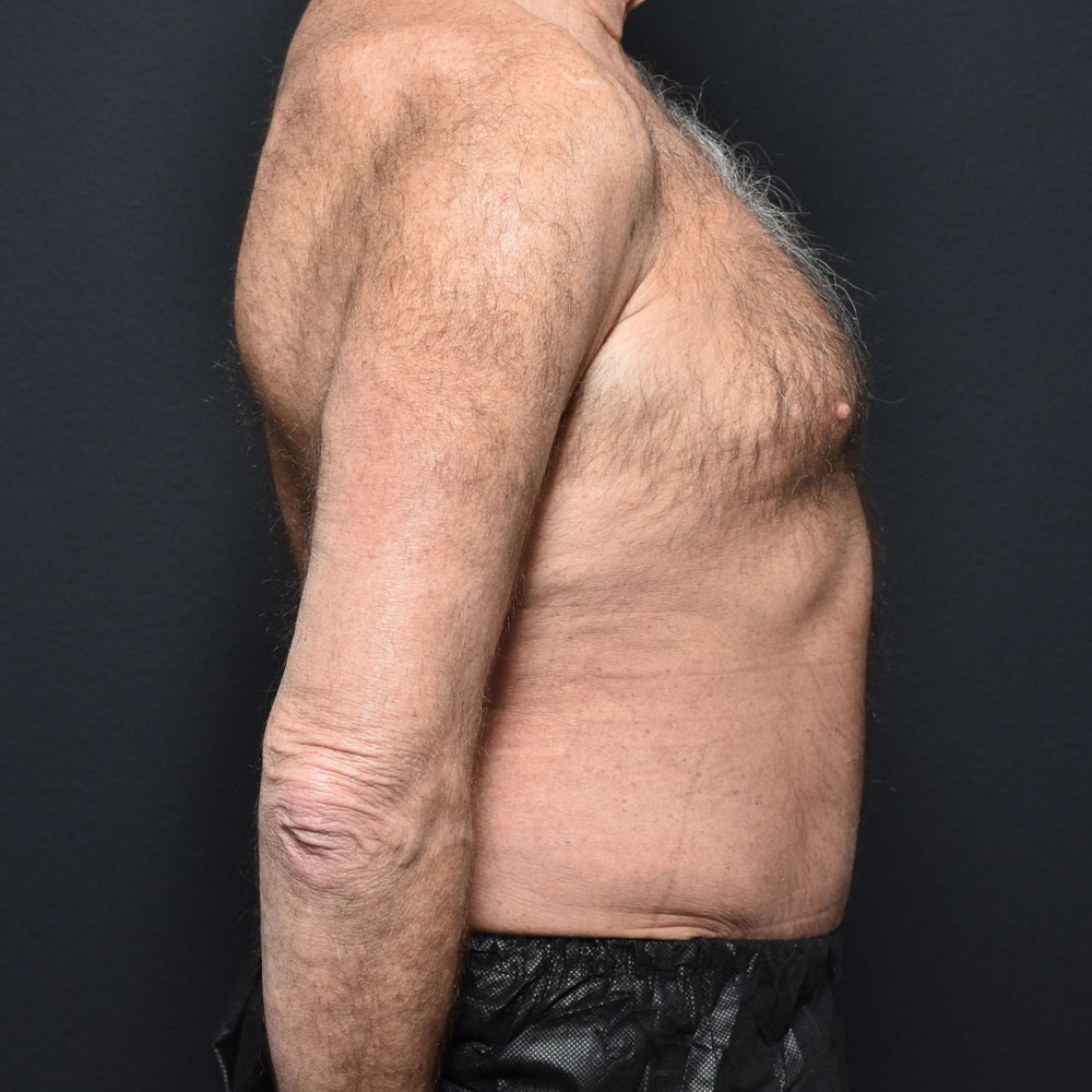 Case 9863 Side View, After Male Tummy Tuck in Lake Oswego & Portland, OR