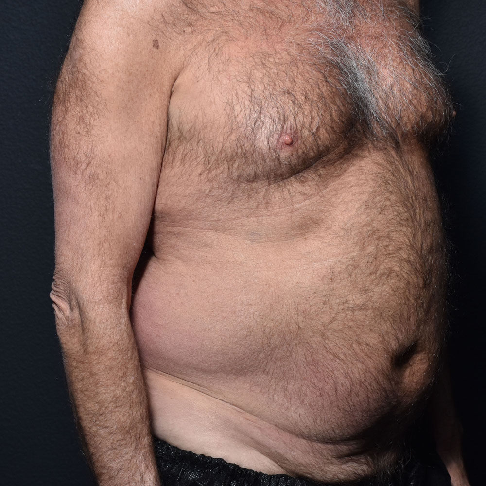 Case 9863 Oblique View, Before Male Tummy Tuck in Lake Oswego & Portland, OR