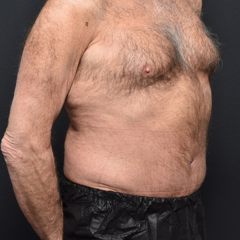 Case 9863 Oblique View, After Male Tummy Tuck in Lake Oswego & Portland, OR