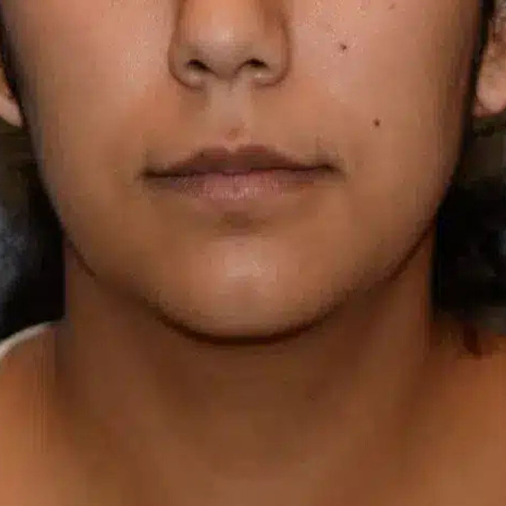 Case--2134 | Before Ultherapy