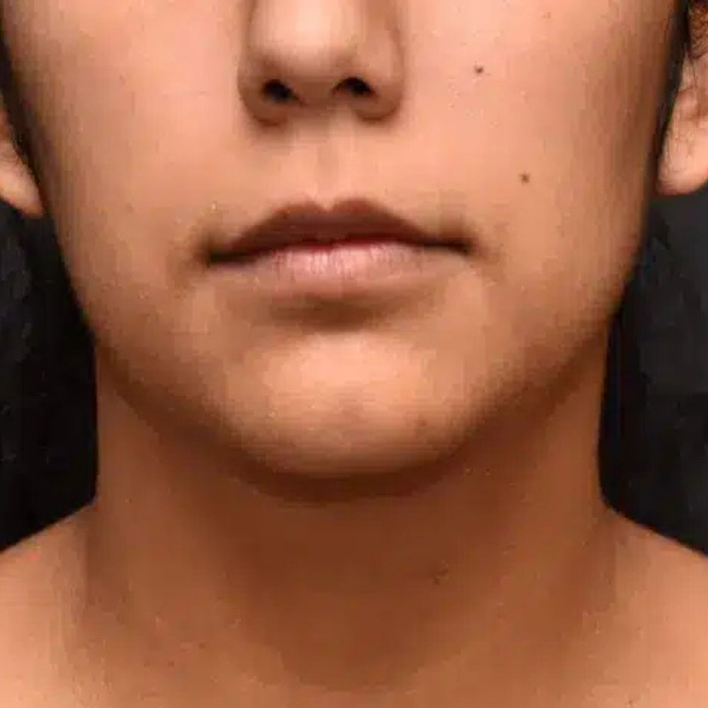 Case--2134 | After Ultherapy