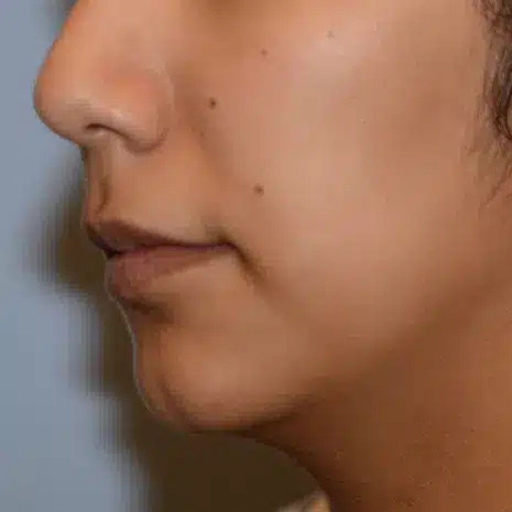 Case--2134 | Before Ultherapy 2