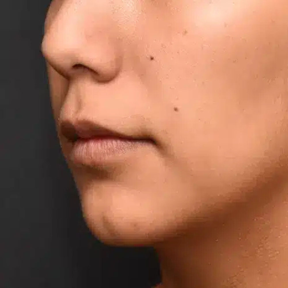 Case--2134 | After Ultherapy 2