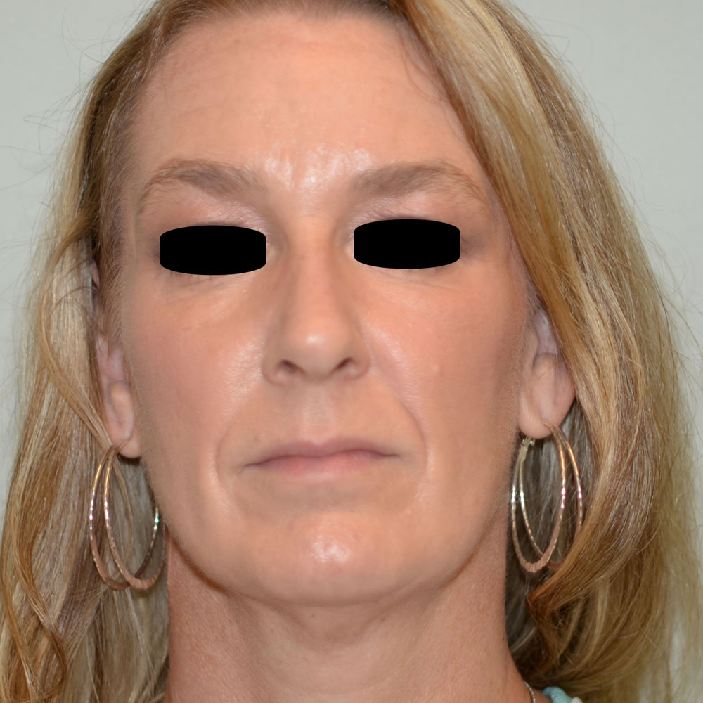 Case--2135 | Before Ultherapy