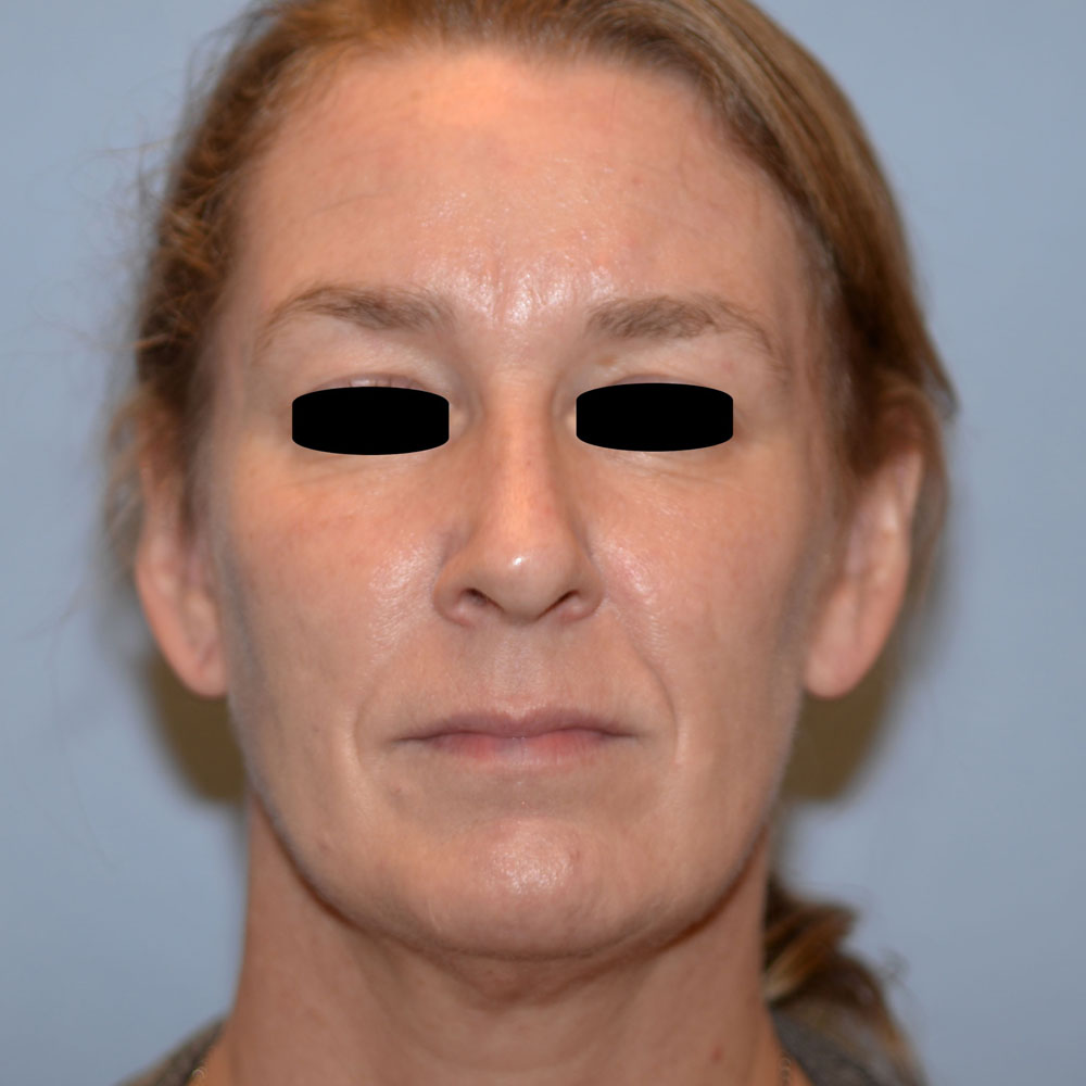 Case--2135 | After Ultherapy