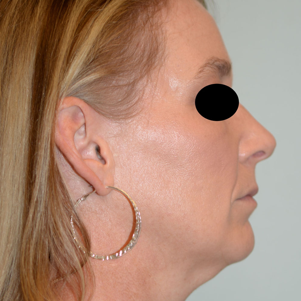 Case--2135 | Before Ultherapy 2