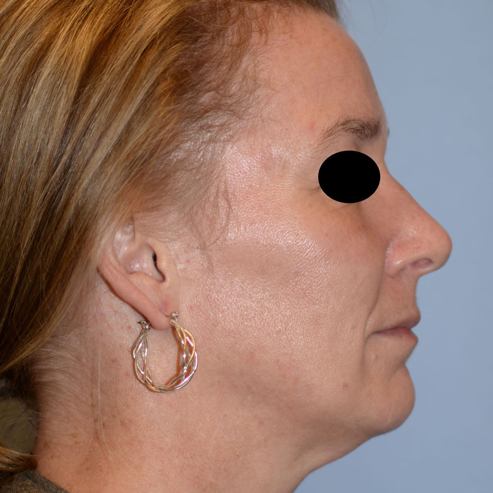 Case--2135 | After Ultherapy 2