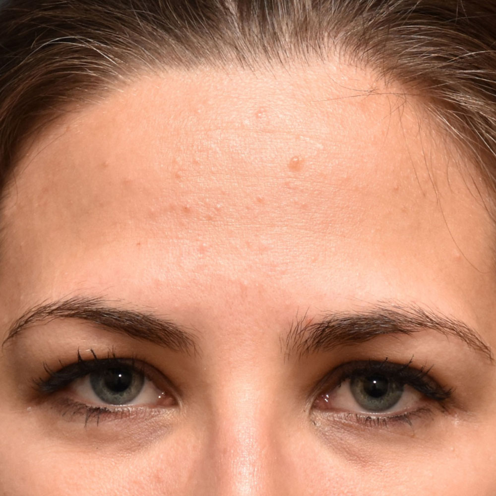 Case--2136 | Before Ultherapy