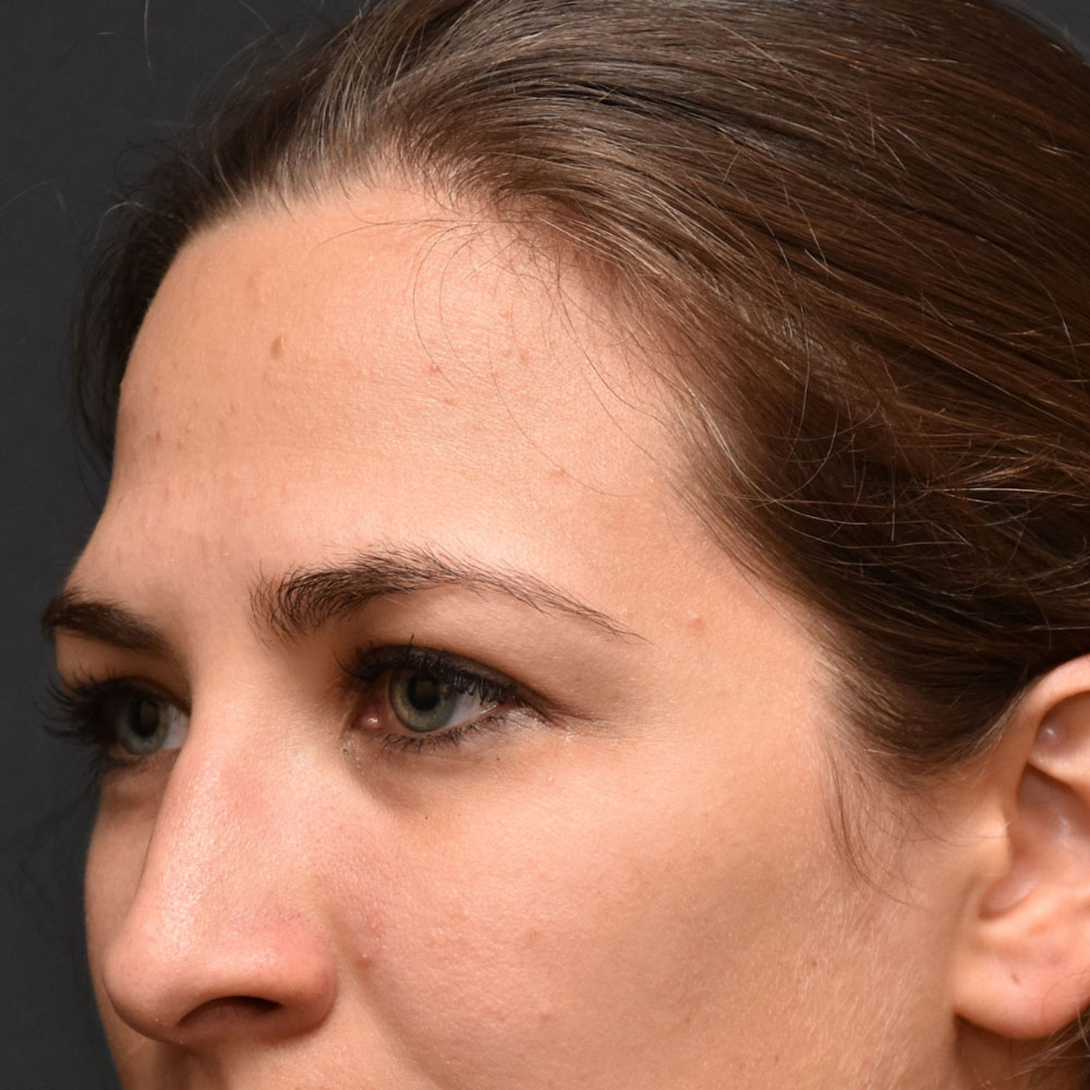 Case--2136 | Before Ultherapy 2