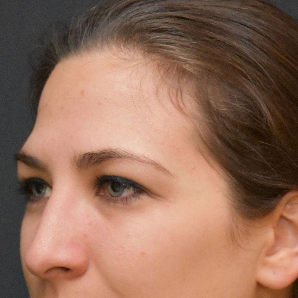 Case--2136 | After Ultherapy 2