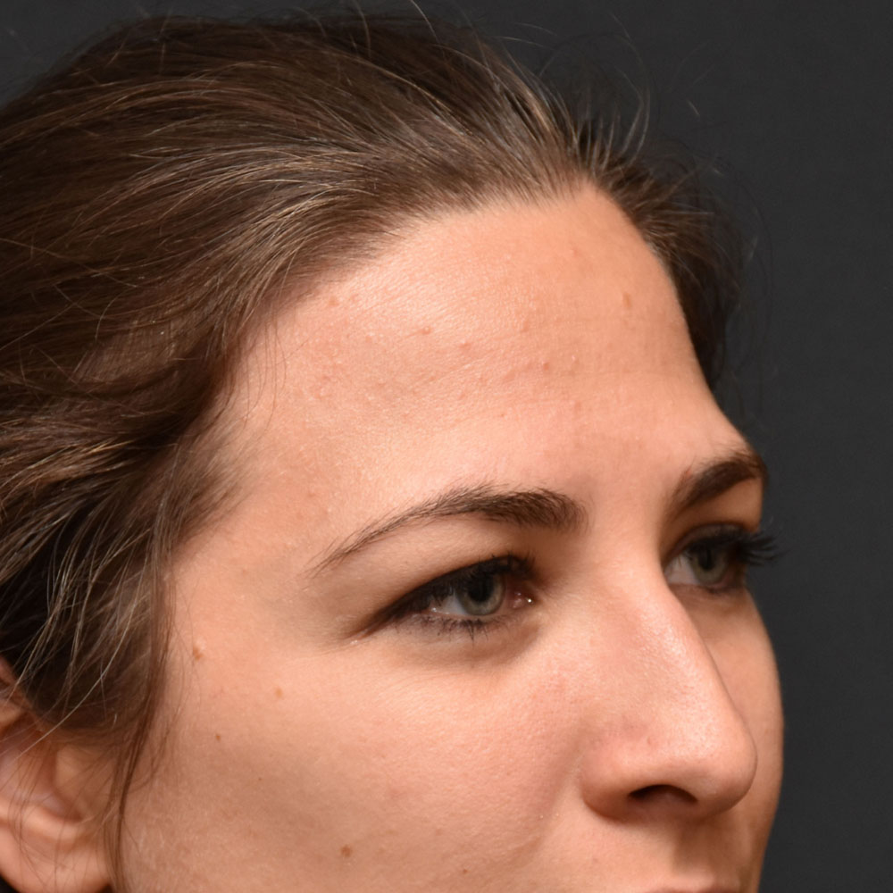 Case--2136 | Before Ultherapy 3