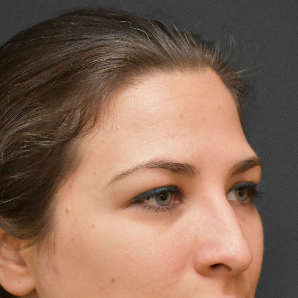 Case--2136 | After Ultherapy 3